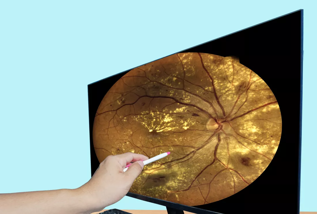 octor-point-lcd-monitor-report-screen-fundus-photography-diabetes-medical-healthcare-concept